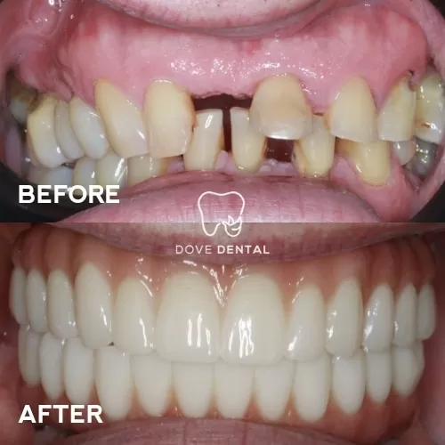 Adam's Smile Makeover Implants And Full-arch-on-implants At Grovedale In Dove Dental