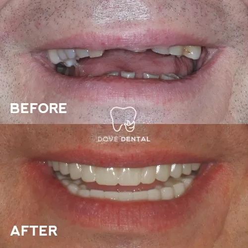 Adam's Smile Makeovers Implants and Full-arch-on-implants In Grovedale - Dove Dental