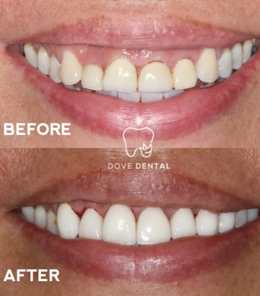 Before and After Veneers_at Waurn Ponds, Geelong_At Dove Dental