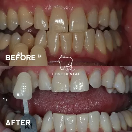 Christopher's Smile Makeover Teeth Whitening In Belmont In Dove Dental