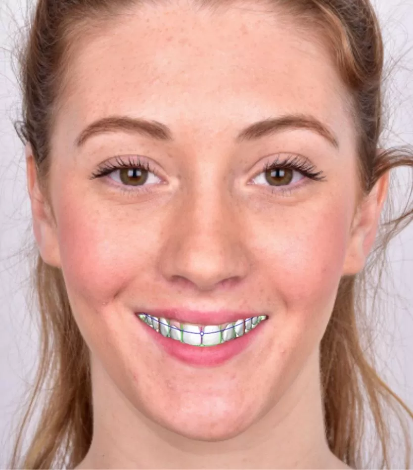 Digital smile design_at Waurn Ponds, Geelong_at Dove Dental