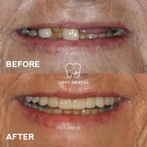 Margaret's Smile Makeovers Implants and Veneers In Highton - Dove Dental
