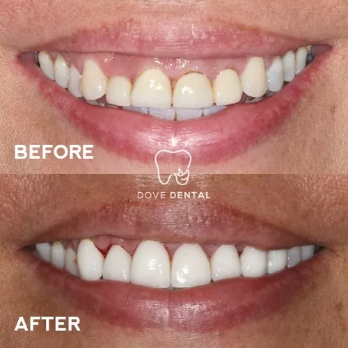 Melissa's Smile Makeovers Veneers In Grovedale - Dove Dental