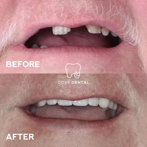 Sharon's Smile Makeover Implants And Veneers In Waurn Ponds - Dove Dental