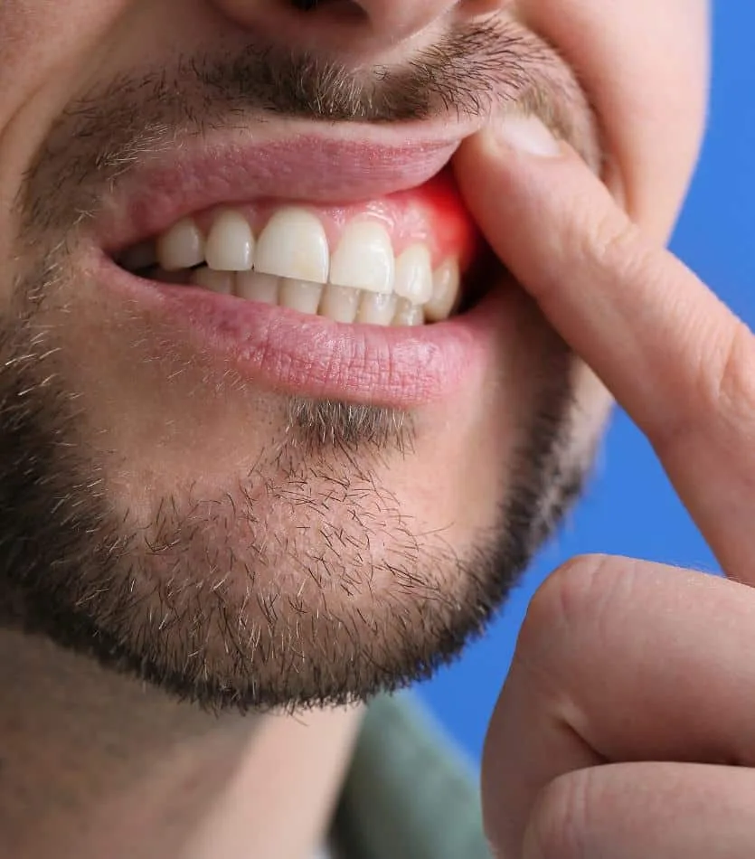 Stages Of Gum Disease In Waurn Ponds, Geelong At Dove Dental