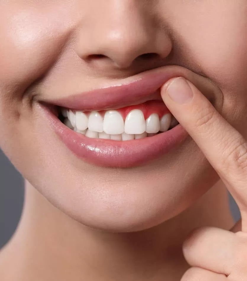 Periodontal / Gum Disease Treatment At Waurn Ponds, Geelong At Dove Dental