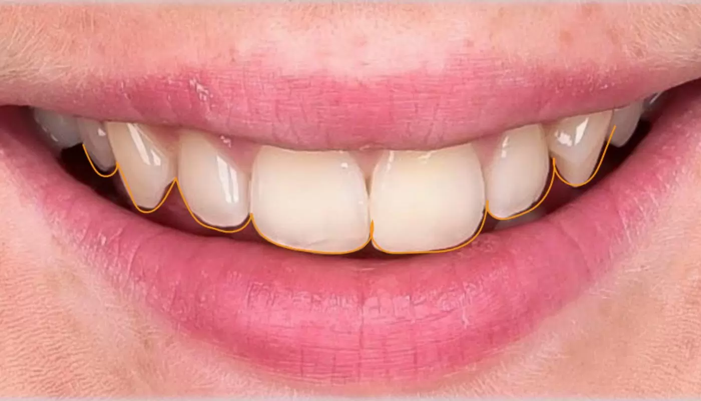 Digital Smile Design At Waurn Ponds, Geelong In Dove Dental