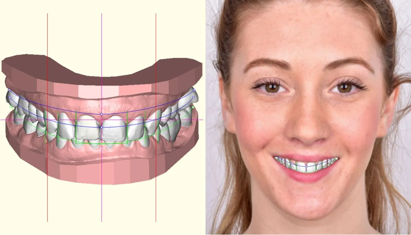 What Is Digital Smile Design In Waurn Ponds, Geelong In Dove Dental