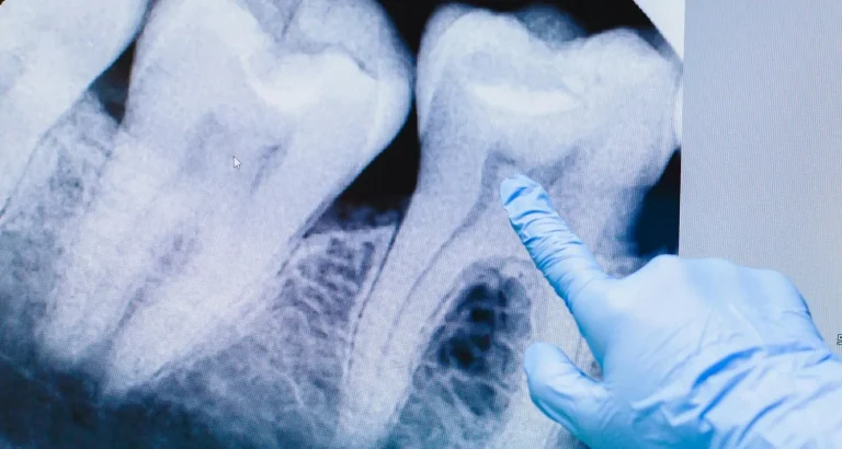 A gloved hand pointing at a molar on a dental x-ray displayed on a screen