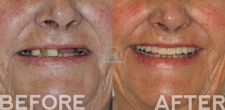 Margaret's Smile Makeover Journey in Highton At Dove Dental