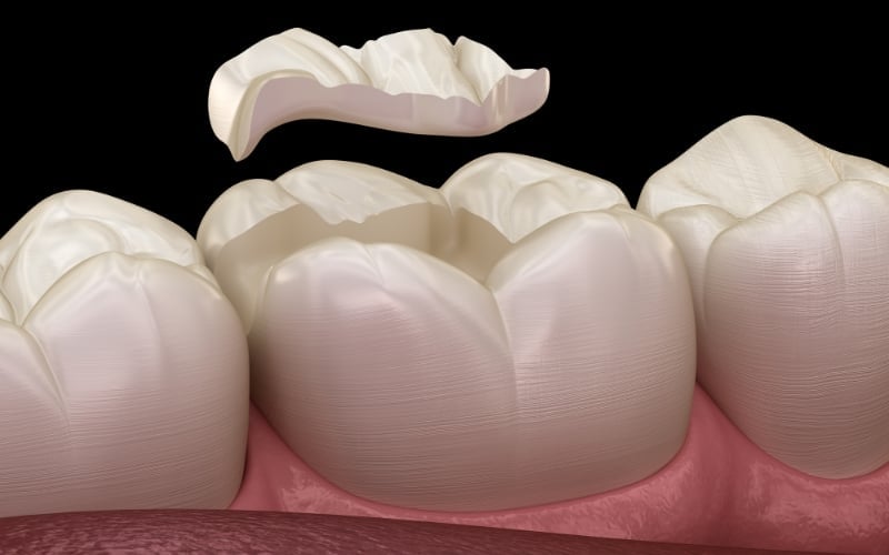 Illustration of a ceramic inlay restoration being seated into a prepared molar