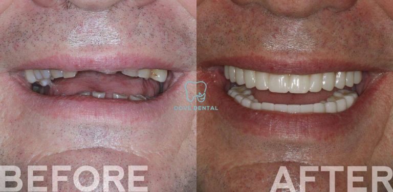 Adam's All-Teeth-on-6 and All-Teeth-on-4 Journey In Grovedale At Dove Dental