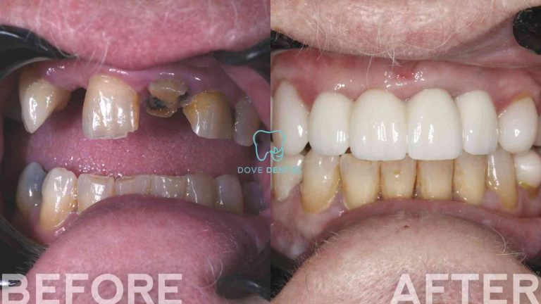 Sharon's Implant and Veneers Treatment in Waurn Ponds At Dove Dental