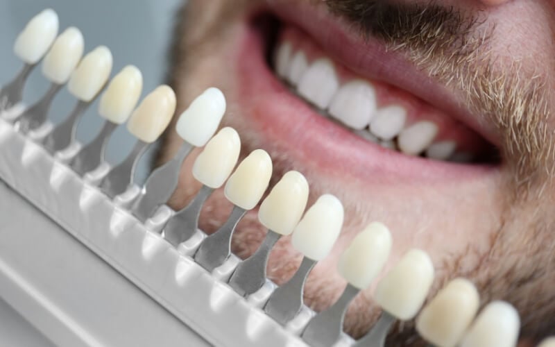 A tooth shade guide held up against a man’s smile to match colour