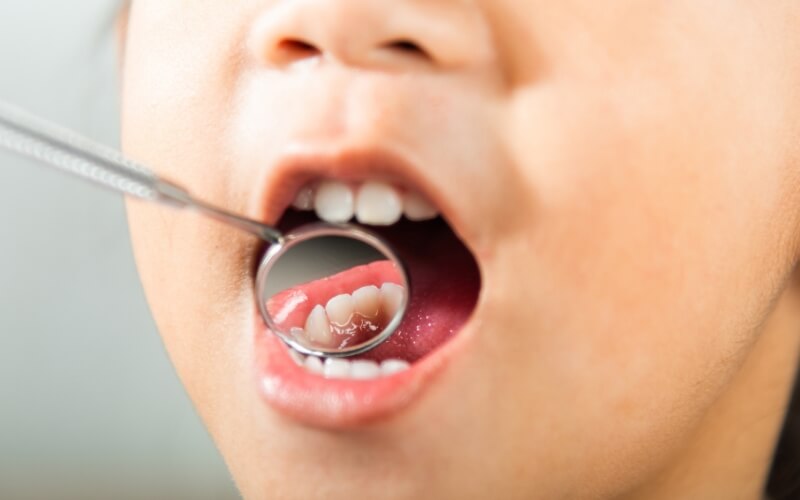 Close-up of an open mouth with a dental mirror examining stained lower teeth