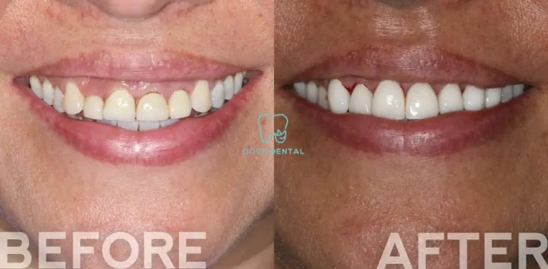 Melissa's Porcelain Veneers Journey in Grovedale At Dove Dental