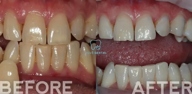 Christopher's Teeth Whitening Journey In Belmont At Dove Dental