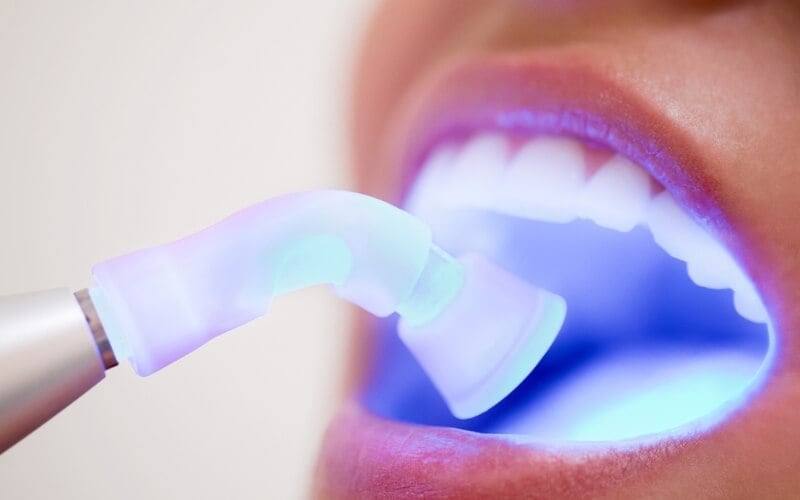 A blue dental curing light being used inside a patient’s mouth