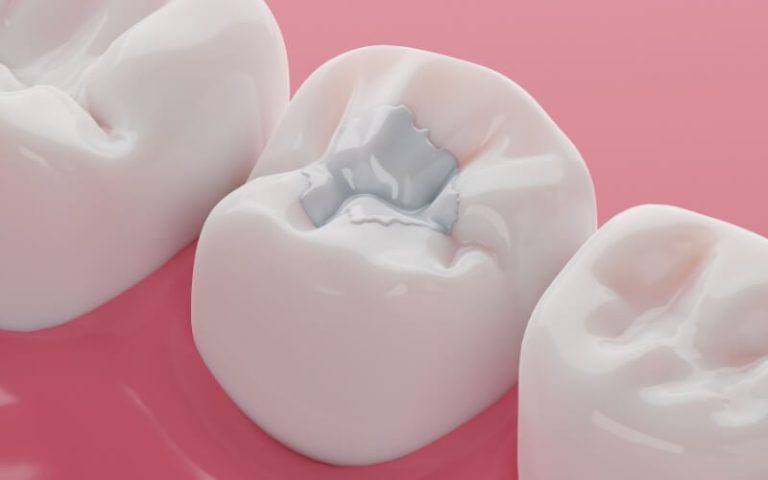 Illustration of a molar restored with a silver amalgam filling