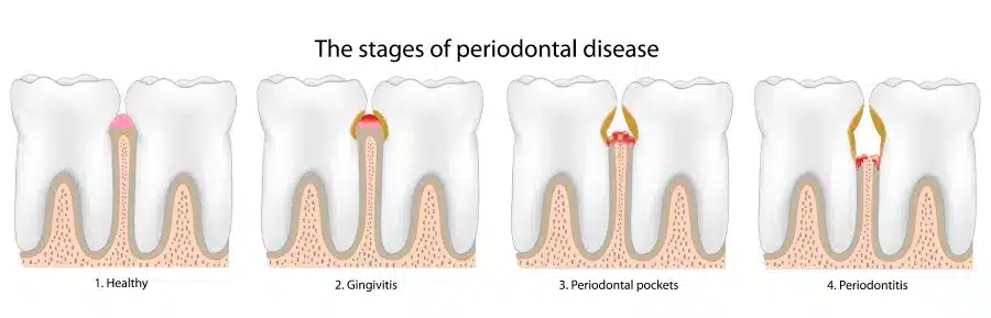 Diagram of the four stages of periodontal disease: healthy gums, gingivitis, periodontal pockets and periodontitis