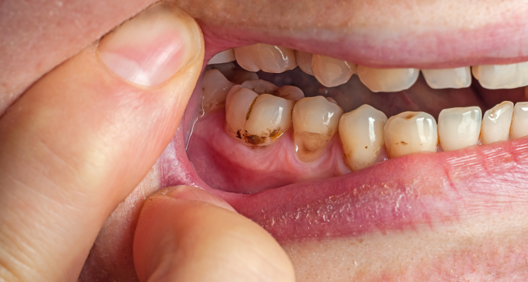 A lip held back to reveal decay at the gum line of a lower molar