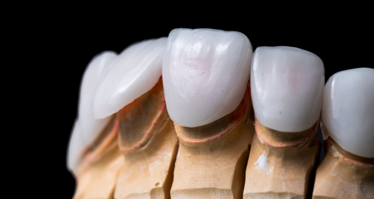 Close-up of porcelain veneers seated on a plaster model of the upper teeth