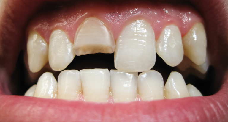 Close-up of an open mouth showing a chipped upper front tooth