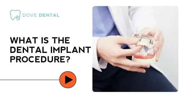 Video thumbnail titled “What Is the Dental Implant Procedure?”