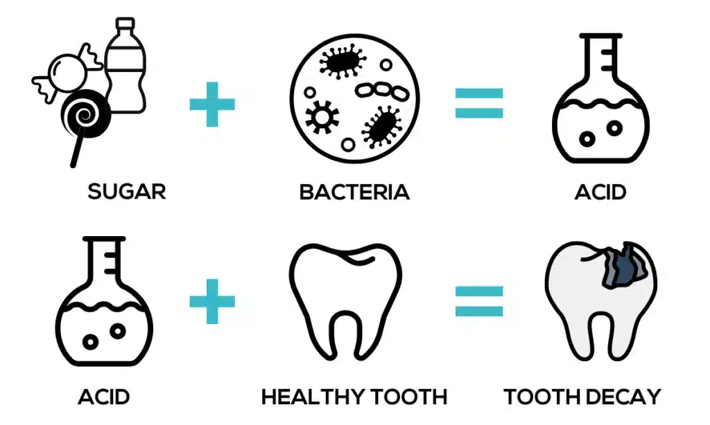 Diagram showing sugar plus bacteria produces acid, and acid plus a healthy tooth produces tooth decay