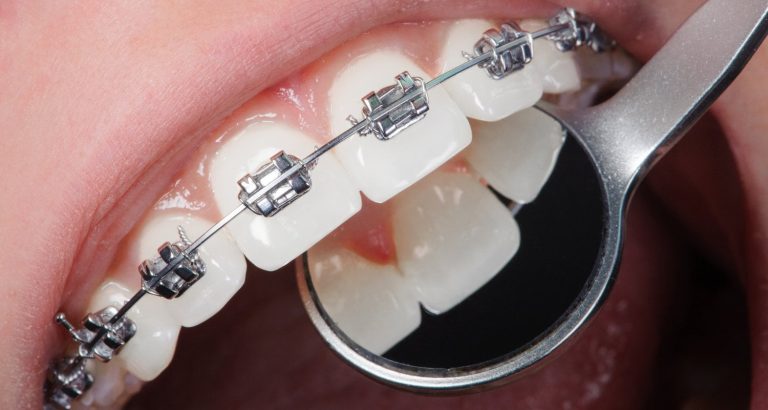 Close-up of upper teeth fitted with metal braces, viewed alongside a dental mirror